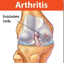 Arthritis