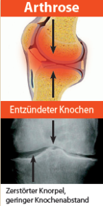 Arthrose