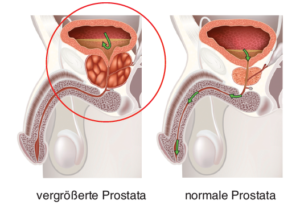 gesunde Prostata