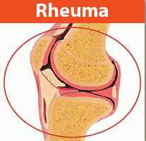 Rheuma